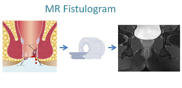 The significance of MR fistulography in pre-operative assessments for perianal fistulas 