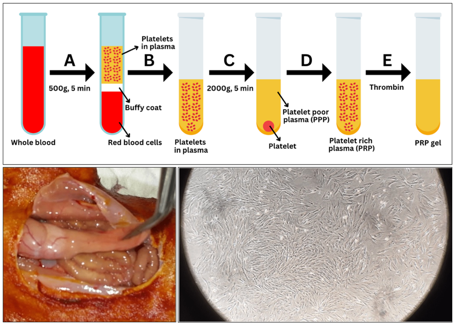 Enhancement of Schwann-like cells differentiation from adipose-derived mesenchymal stem cells by administration of platelet-rich plasma: An in vitro study 