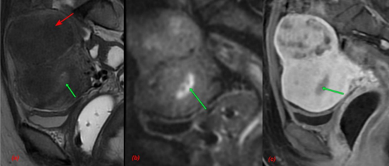 The role of 3.0 tesla diffusion-weighted magnetic resonance imaging in evaluating the depth of myometrial invasion and predicting the histological grade of endometrial cancer 